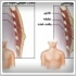 ژنيكوماستي Gynecomastia - بزرگي سينه در مردان